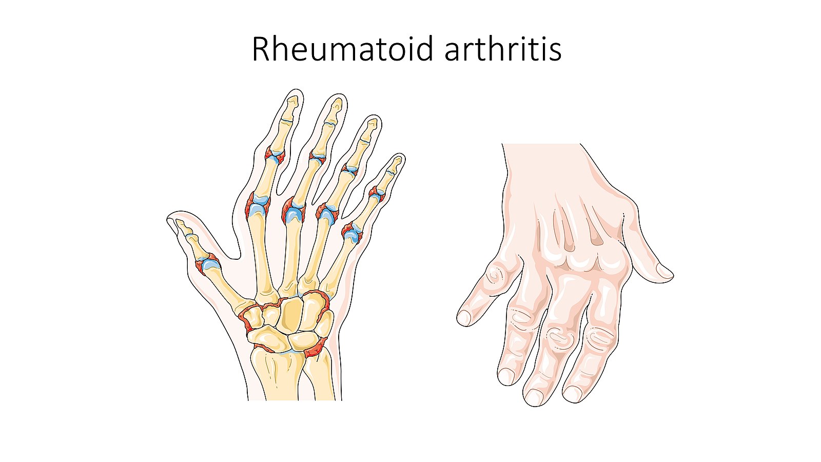 GUM DISEASE AND RHEUMATOID ARTHRITIS - DENTAFORTE™